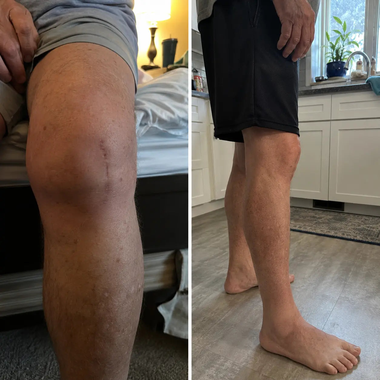 Customer knee recovery progress before and after